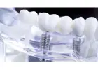 Affordable Dental Implants – Restore Your Smile Today!