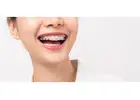 Perfect Your Teen’s Smile with Expert Braces in Singapore