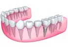 Dental implants in Islamabad