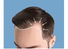 Hair Transplant Near Me