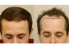 Get Your Hair Back with Advanced Hair Transplant in Multan