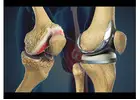 Best Knee Replacement Surgeon in Vaishali Nagar – Dr. Arvind Asopa