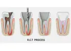 Save Your Tooth – Advanced Root Canal Treatment in Noida