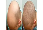 Hair Transplant Surgery In Florida