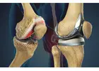Best Orthopedic Surgeon in Indore for Complete Bone Care
