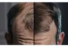 Best Solution for Thinning Hair with Personalized Treatment Care