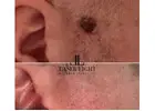 Laser removal of skin tag