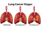 Lung Cancer Singapore: Symptoms, Diagnosis and Early Detection