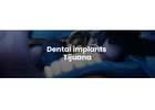 Dental implants Tijuana offers natural-looking and durable teeth replacements 