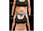 Liposuction Plastic Surgeon Cherry Creek