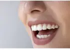 Tooth Color Fillings in Mount Roskill, Auckland