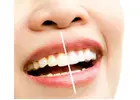 Professional Teeth Whitening PA Services Delivering Brighter Smiles With Comfortable Modern Dental C