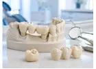Durable Dental Crowns and Bridges for Missing or Damaged Teeth