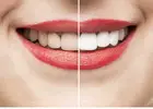 Teeth Whitening in Mount Roskill, Auckland