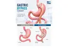Consult Laparoscopic Gastric Bypass Surgery in India Experts