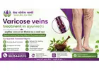 Effective Varicose Veins Treatment in Ayurveda for Natural Relief