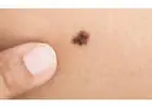 Mole Check