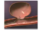 Endovascular Coiling Surgery for Brain Aneurysm | IR Facilities