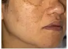 Affordable Pigmentation Removal Treatment in Delhi – Book Today