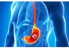 Advanced Gastrointestinal Cancer Surgery in Delhi – Book Consultation