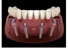 All-on-4 Dental Implants in Tijuana, Mexico – Affordable, Life-Changing Results!