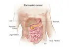 Pancreatic Cancer Treatment in Delhi – Expert & Advanced Care