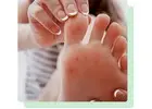 Treatment For Flat Feet New Brunswick