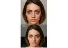 Dark Circles Under Eyes Treatment in Delhi | Laser, PRP & Peel
