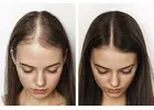 Hair Loss Solutions Dallas | Women’s Thinning Hair Specialist