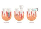 Same-Day Crowns  in Las Vegas at Functional Aesthetic Dentistry