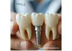 Dental Implant Products Wholesale in Mexico For Best Deals