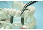 Trusted Dental Implant Contract Manufacturing for Clinics