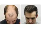 Female Hair Transplant Cost in India – Affordable & Trusted at Medlinks